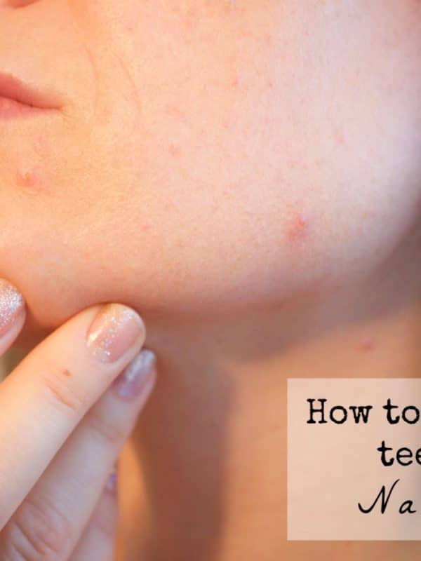 how to get rid of acne naturally
